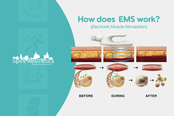 EMS treatment for post pregnancy weight loss treatment Hereford