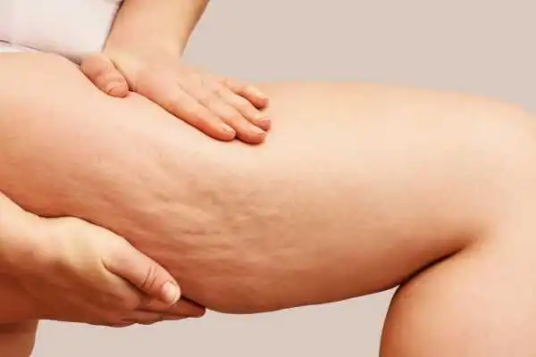 Image of woman showing leg with cellulite Hereford