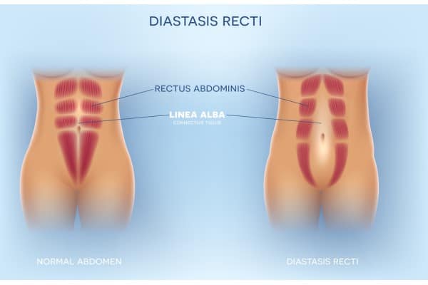 What Non-Surgical Options Are Available for Diastasis Recti Hereford?