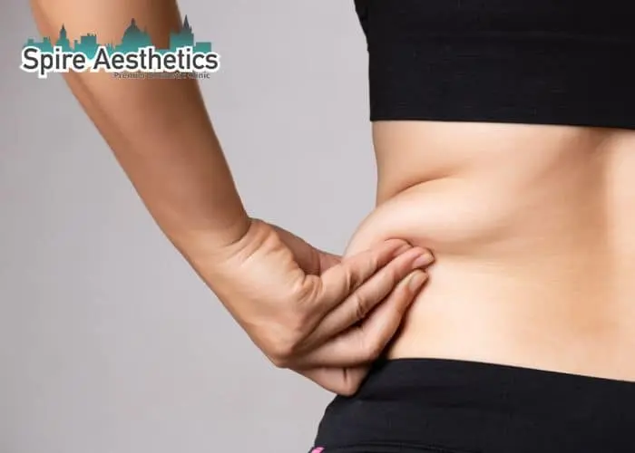 Image of woman pinching fat on their hips Hereford. Fat Freezing treatment