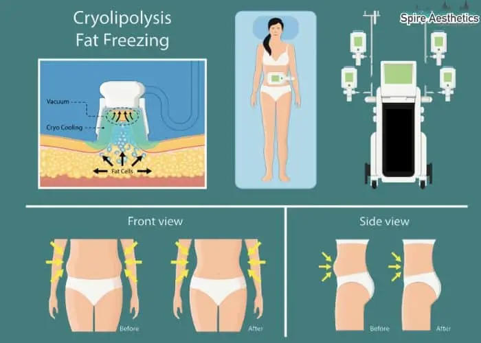 Fat freezing treatment Hereford benefits for competitions to remove stubborn fat deposits.