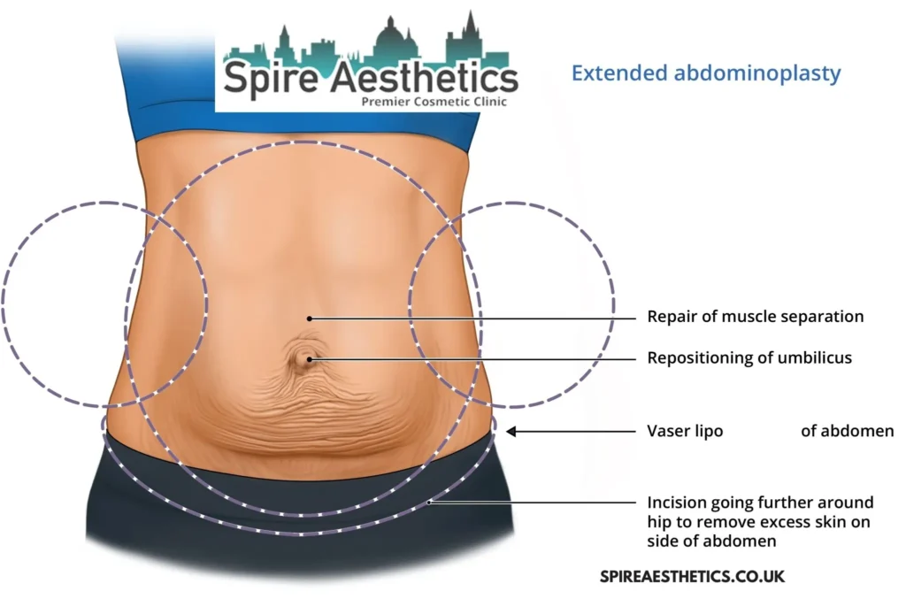 Understanding Loose Skin After Gastric Band Hereford Surgery and HIFU Treatment