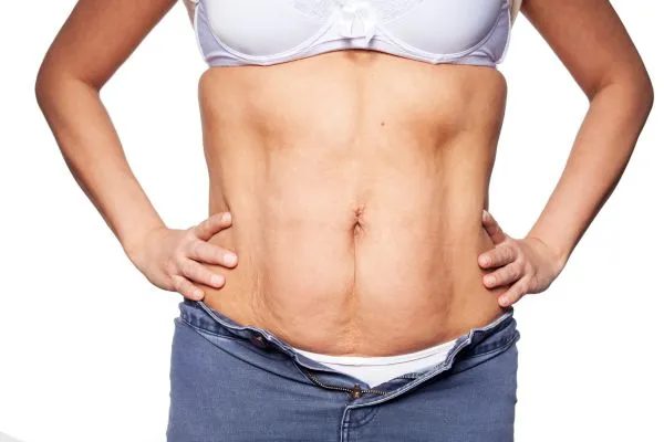 sagging skin on woman's stomach after weight loss injections Hereford