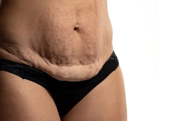 Image of womans stomach after weight loss injections Hereford showing saggy skin