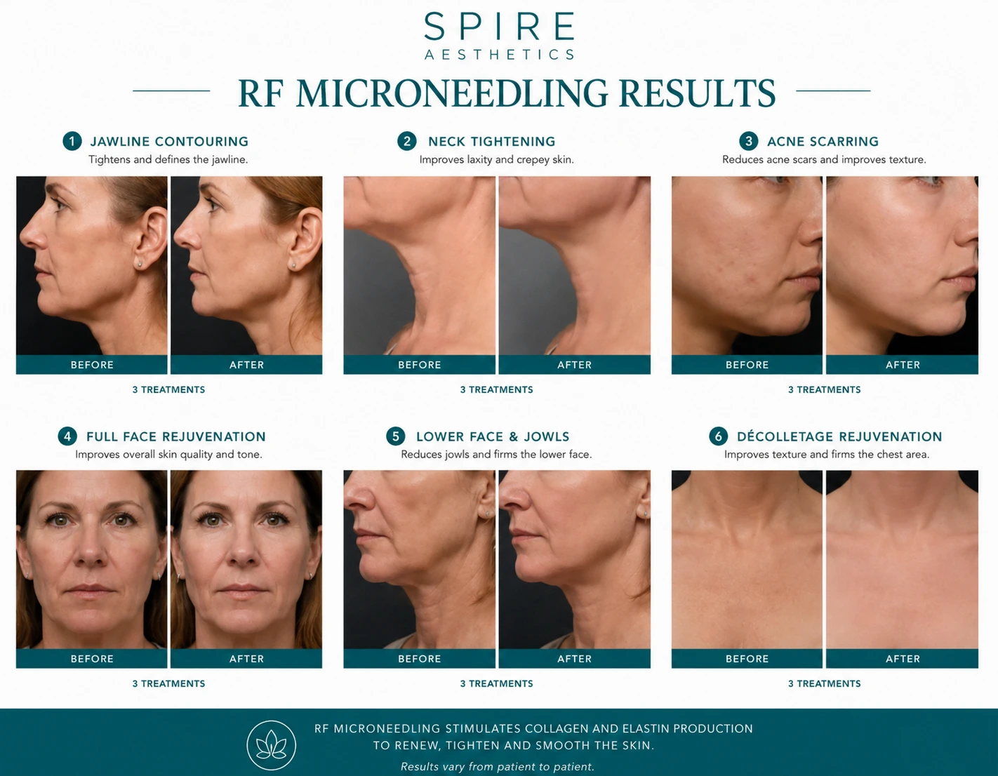 RF Microneedling Skin tightening Hereford results