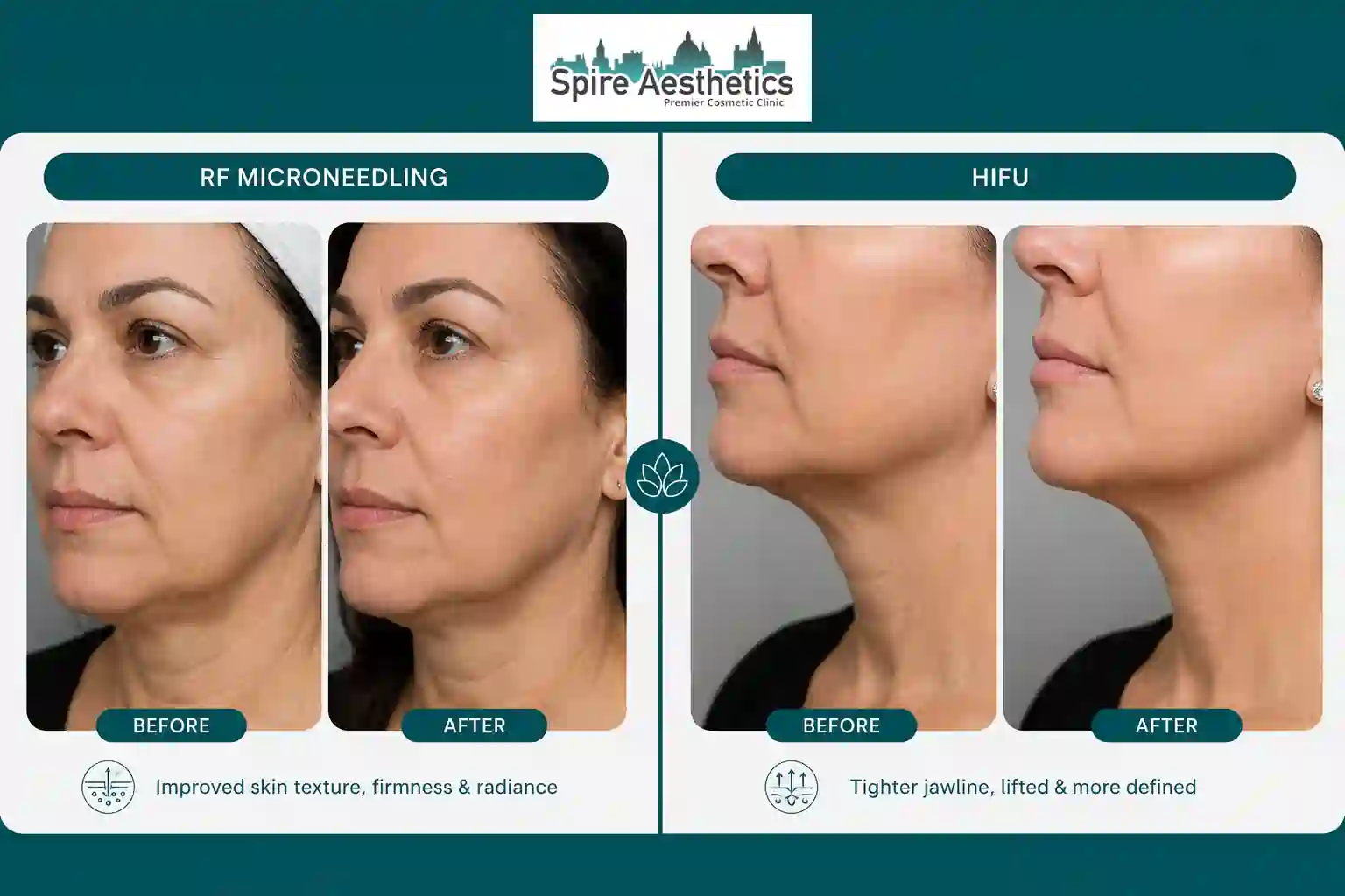 Can RF Microneedling and HIFU Be Combined Hereford?