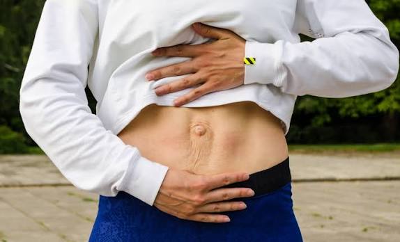 When Could Diastasis Recti Be the Missing Piece of the Puzzle Hereford?