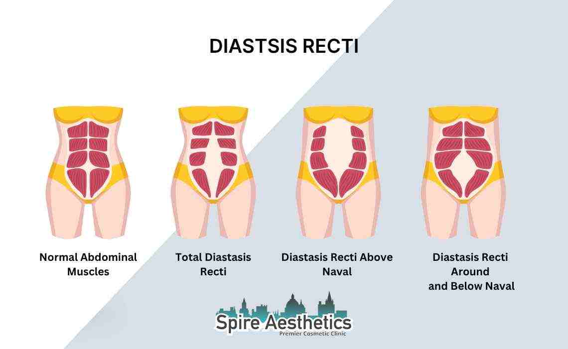 Is Non-Surgical Diastasis Recti Treatment Right for You? Common Concerns Answered Hereford